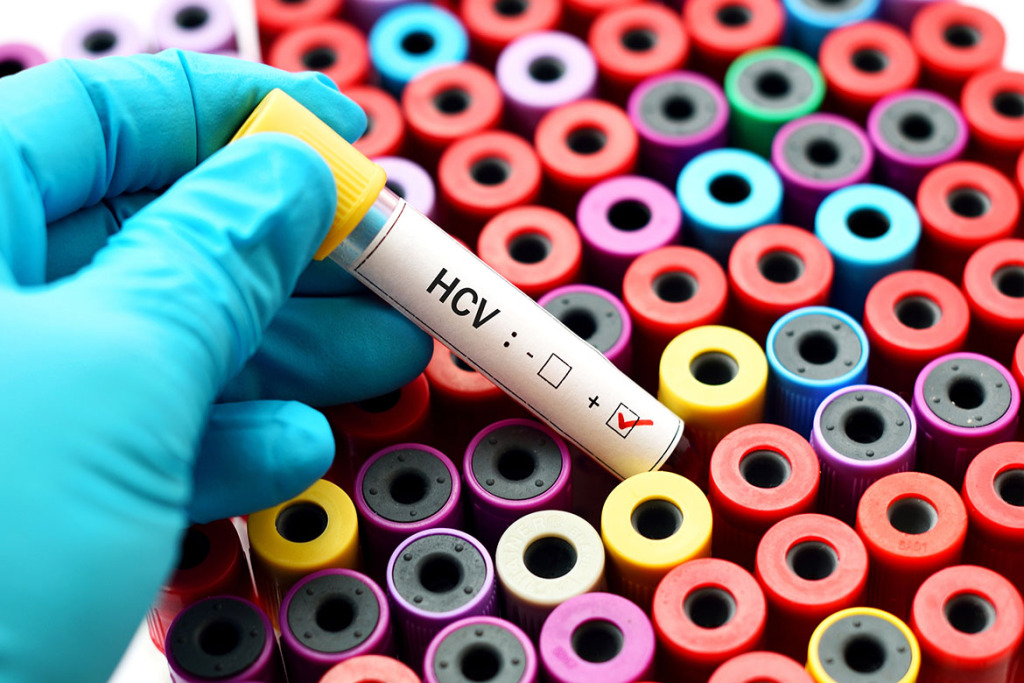 En marxa el Programa Girona 0 per eradicar l’hepatitis C entre les persones de la xarxa de Salut Mental i les Addicions de la Regió Sanitària de Girona